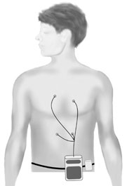 Holter monitor